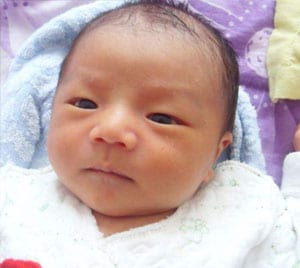 Jaundice In Newborn Baby